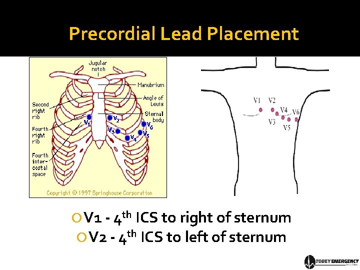 Precordial Lead Placement V 1 - 4 th ICS to right of sternum V