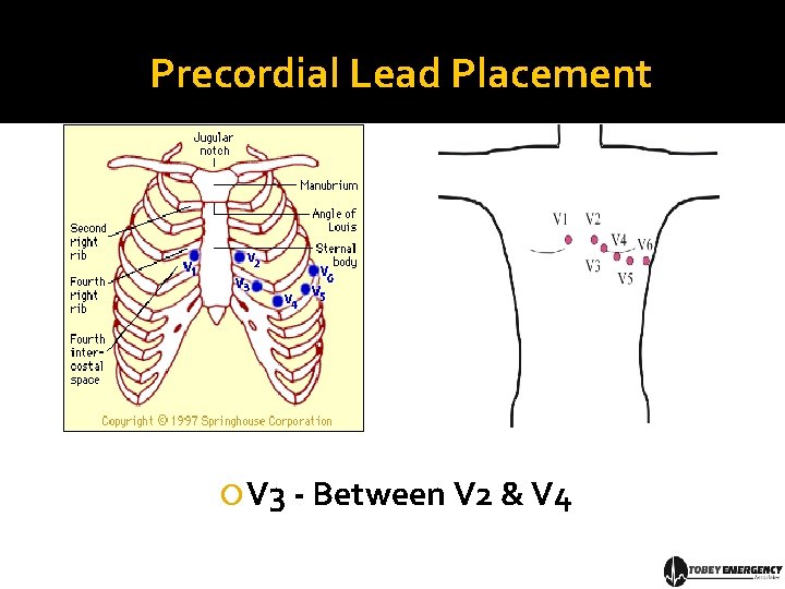 Precordial Lead Placement V 3 - Between V 2 & V 4 