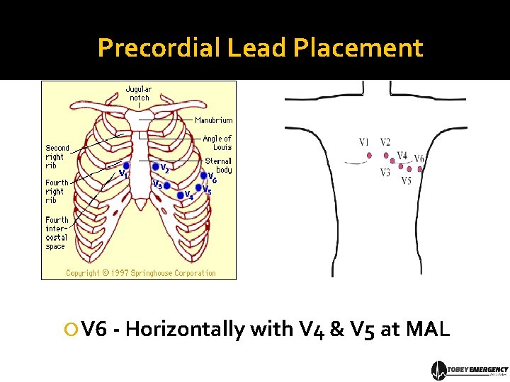 Precordial Lead Placement V 6 - Horizontally with V 4 & V 5 at