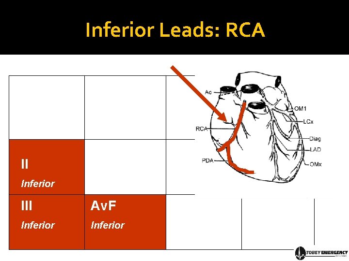 Inferior Leads: RCA II Inferior III Av. F Inferior 