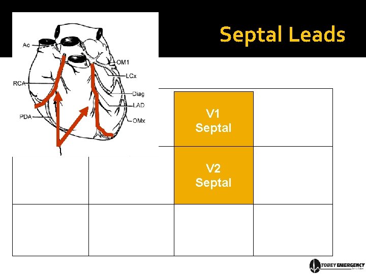 Septal Leads V 1 Septal V 2 Septal 