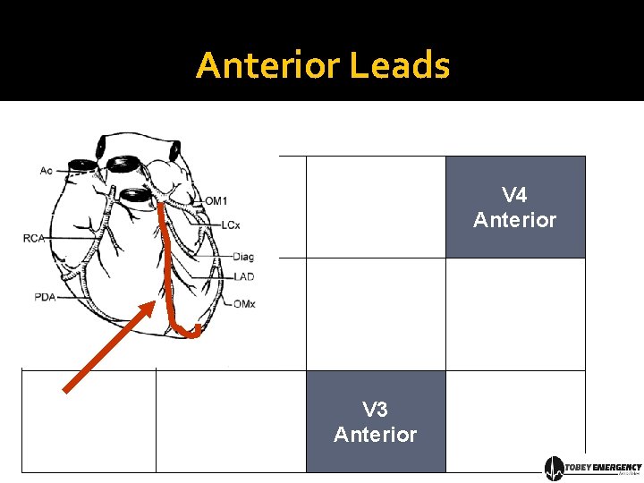 Anterior Leads V 4 Anterior V 3 Anterior 