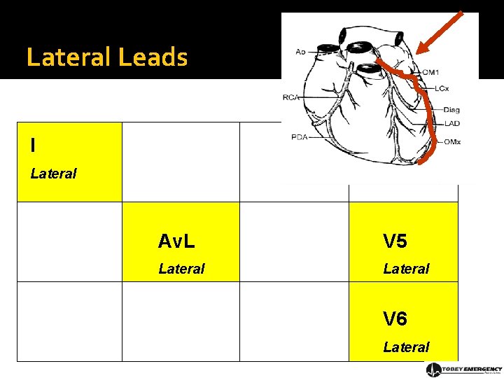 Lateral Leads I Lateral Av. L V 5 Lateral V 6 Lateral 