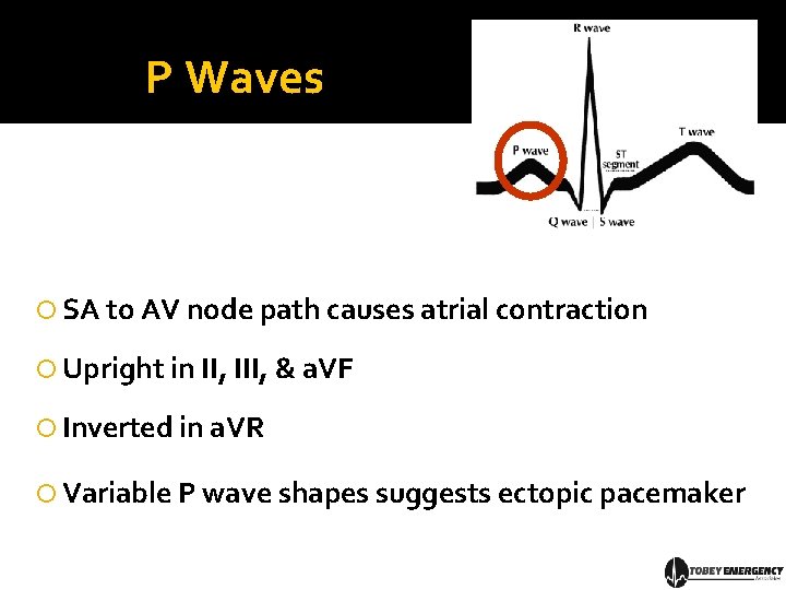 P Waves SA to AV node path causes atrial contraction Upright in II, III,