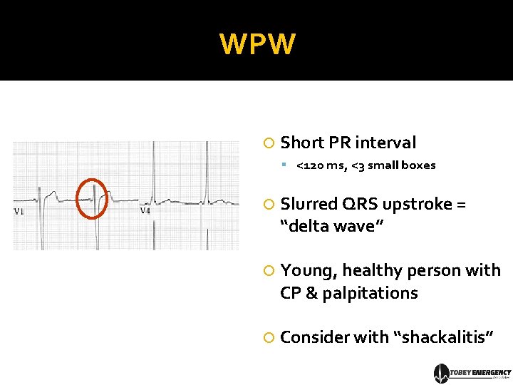 WPW Short PR interval <120 ms, <3 small boxes Slurred QRS upstroke = “delta