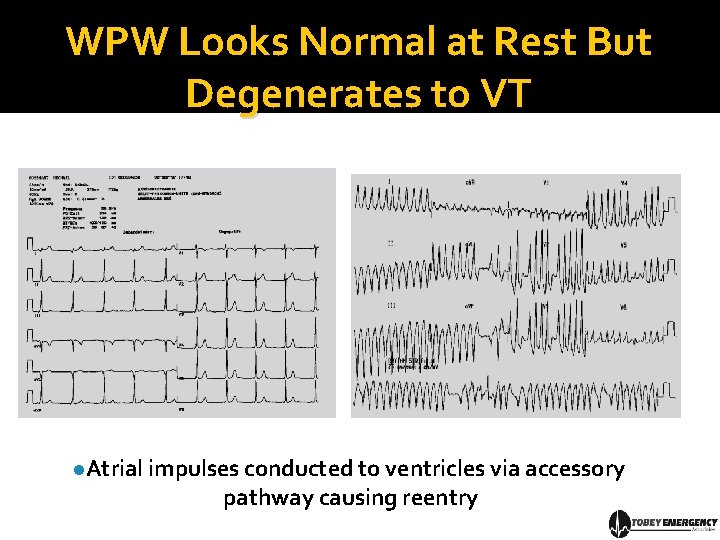 WPW Looks Normal at Rest But Degenerates to VT l. Atrial impulses conducted to