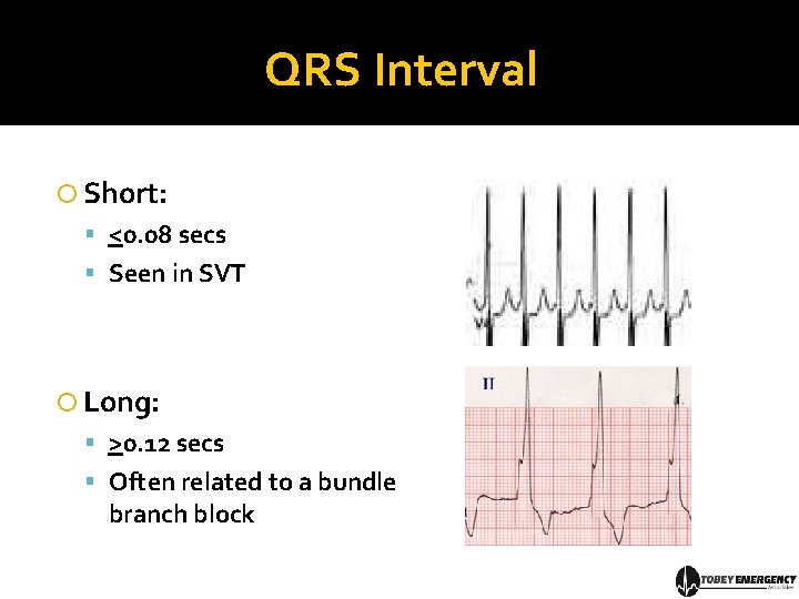QRS Interval Short: <0. 08 secs Seen in SVT Long: >0. 12 secs Often