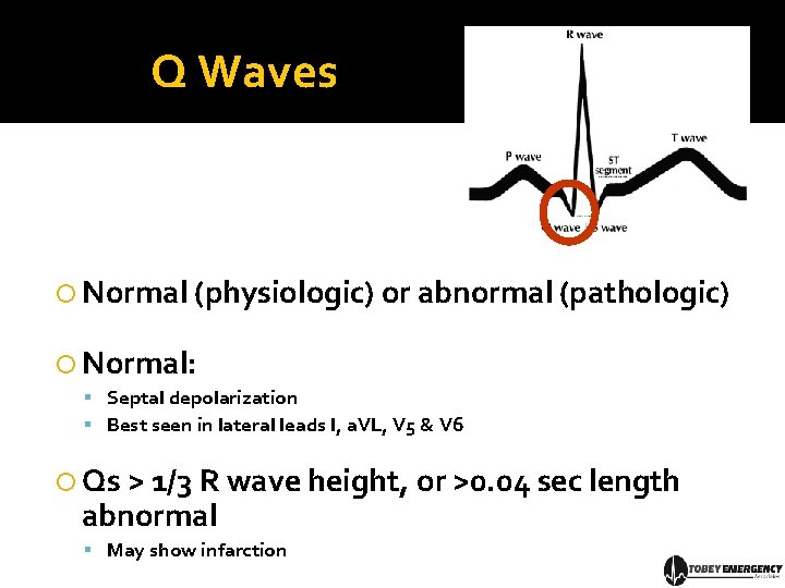 Q Waves Normal (physiologic) or abnormal (pathologic) Normal: Septal depolarization Best seen in lateral