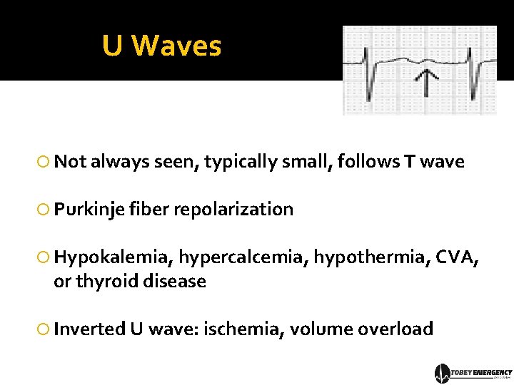 U Waves Not always seen, typically small, follows T wave Purkinje fiber repolarization Hypokalemia,