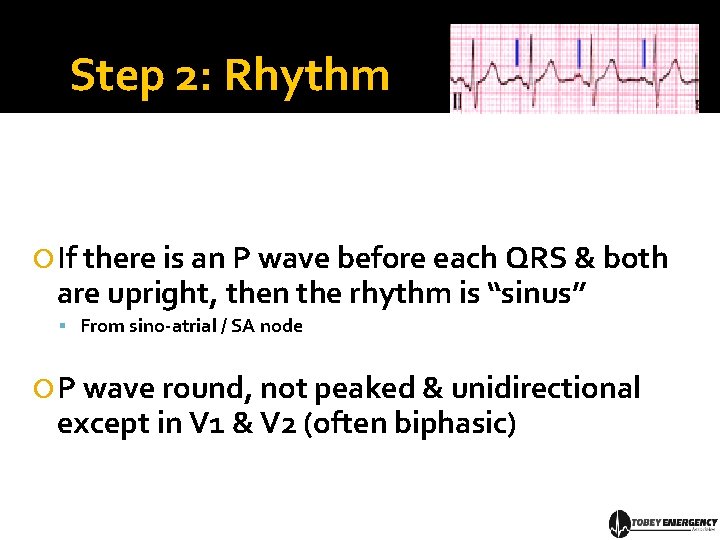 Step 2: Rhythm If there is an P wave before each QRS & both