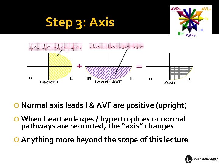 Step 3: Axis Normal axis leads I & AVF are positive (upright) When heart