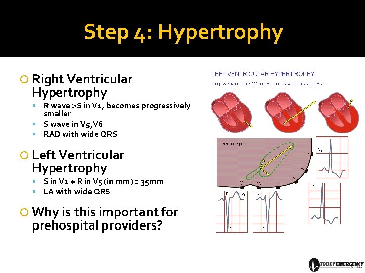Step 4: Hypertrophy Right Ventricular Hypertrophy R wave >S in V 1, becomes progressively