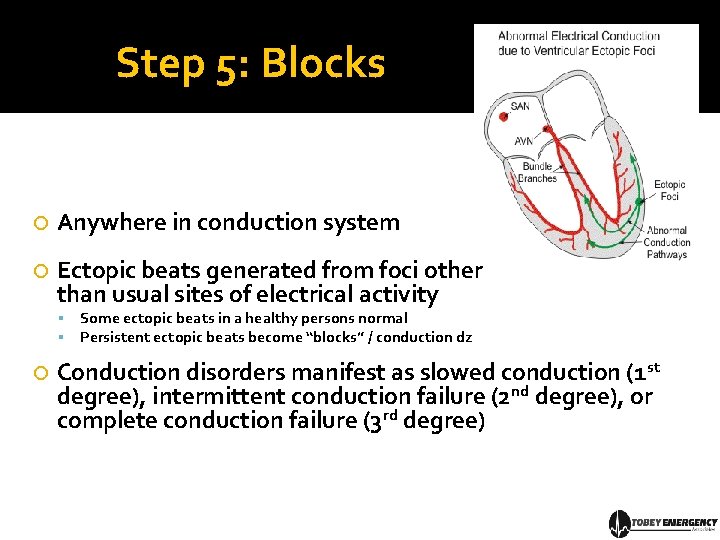 Step 5: Blocks Anywhere in conduction system Ectopic beats generated from foci other than