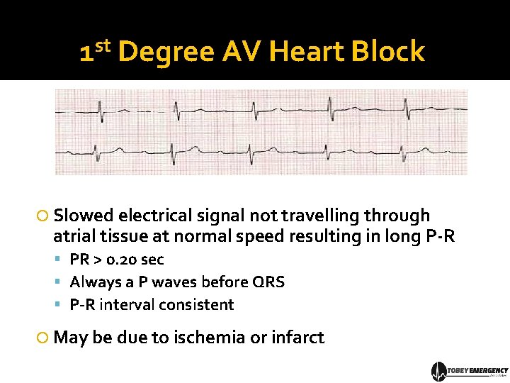1 st Degree AV Heart Block Slowed electrical signal not travelling through atrial tissue