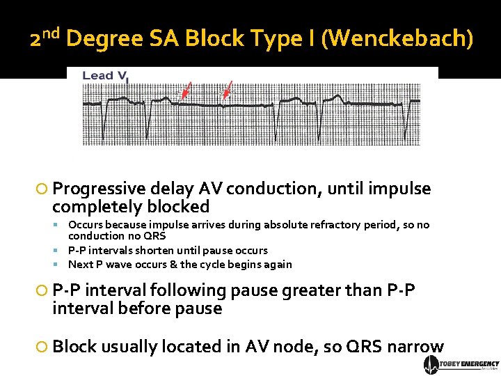 2 nd Degree SA Block Type I (Wenckebach) Progressive delay AV conduction, until impulse