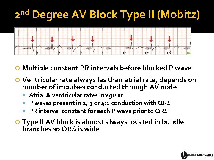 2 nd Degree AV Block Type II (Mobitz) Multiple constant PR intervals before blocked