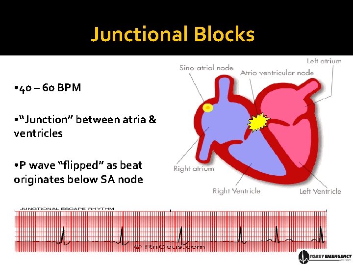 Junctional Blocks • 40 – 60 BPM • “Junction” between atria & ventricles •