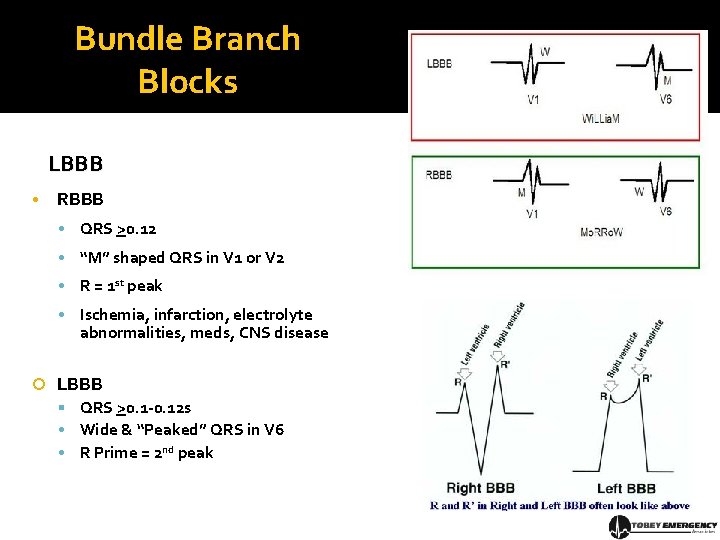 Bundle Branch Blocks LBBB • RBBB • QRS >0. 12 • “M” shaped QRS