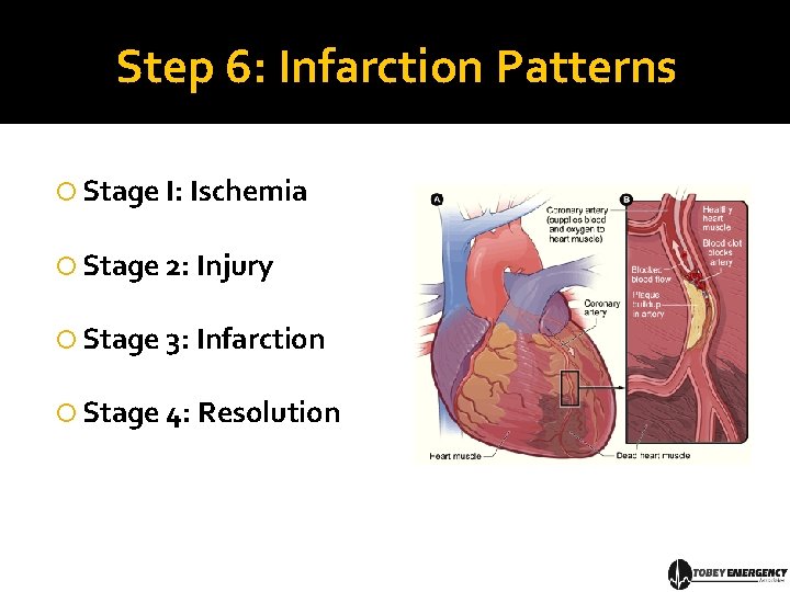 Step 6: Infarction Patterns Stage I: Ischemia Stage 2: Injury Stage 3: Infarction Stage