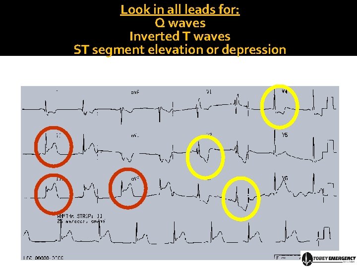 Look in all leads for: Q waves Inverted T waves ST segment elevation or