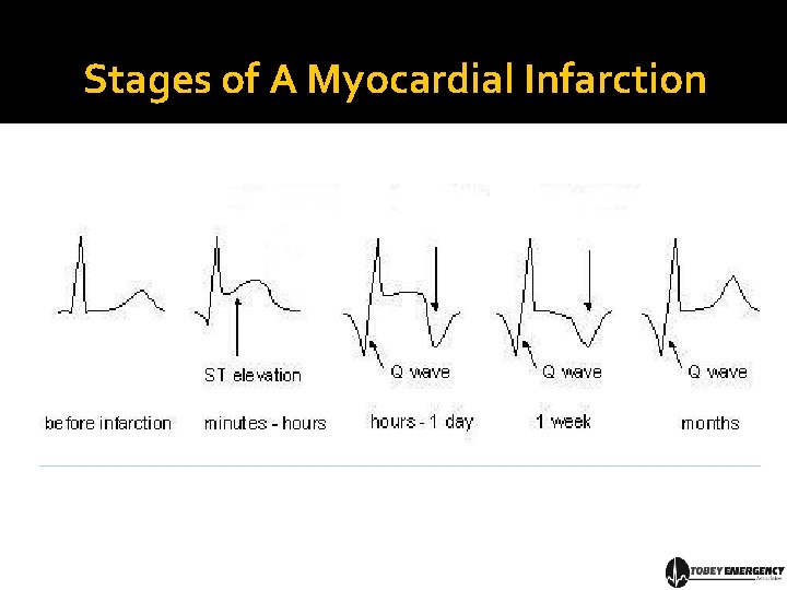 Stages of A Myocardial Infarction 