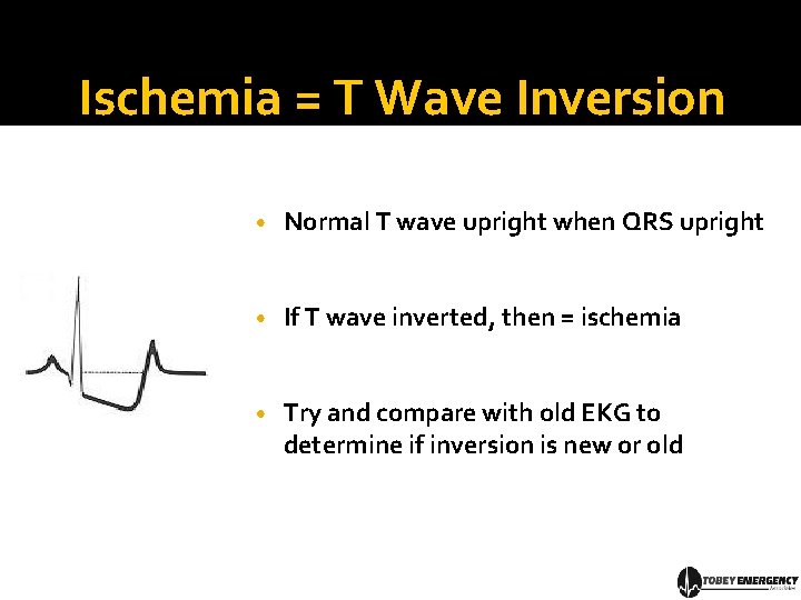 Ischemia = T Wave Inversion • Normal T wave upright when QRS upright •