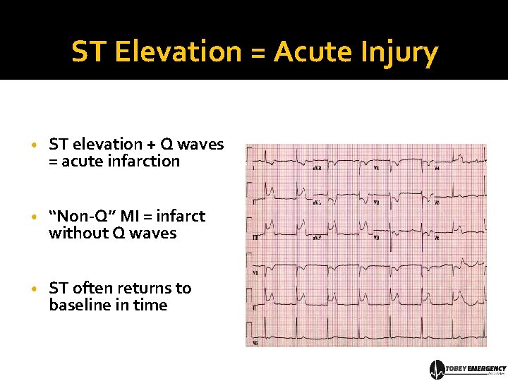 ST Elevation = Acute Injury • ST elevation + Q waves = acute infarction