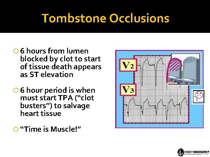 Tombstone Occlusions 6 hours from lumen blocked by clot to start of tissue death