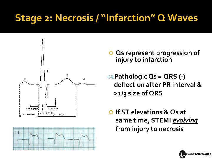 Stage 2: Necrosis / “Infarction” Q Waves Qs represent progression of injury to infarction