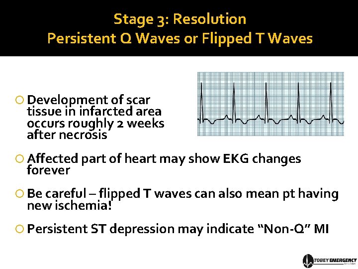 Stage 3: Resolution Persistent Q Waves or Flipped T Waves Development of scar tissue