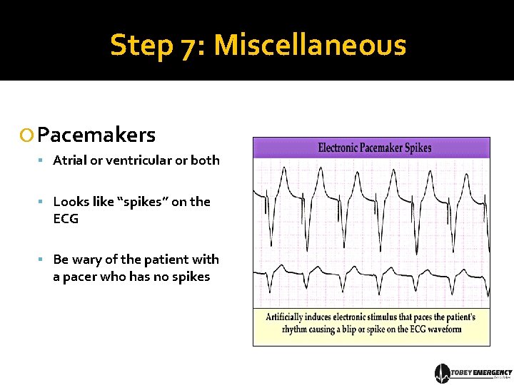 Step 7: Miscellaneous Pacemakers Atrial or ventricular or both Looks like “spikes” on the