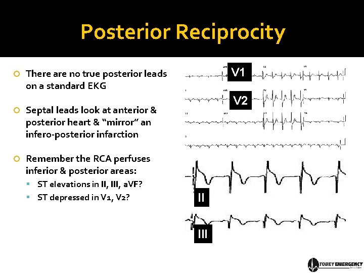 Posterior Reciprocity V 1 There are no true posterior leads on a standard EKG