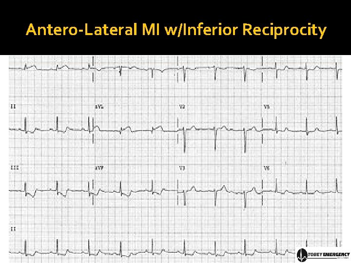 Antero-Lateral MI w/Inferior Reciprocity 