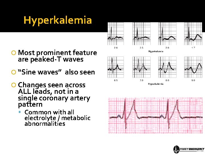 Hyperkalemia Most prominent feature are peaked-T waves “Sine waves” also seen Changes seen across