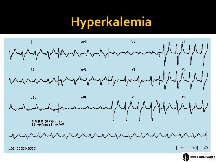 Hyperkalemia 