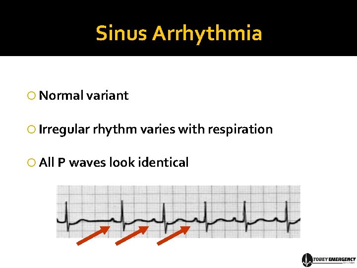 Sinus Arrhythmia Normal variant Irregular rhythm varies with respiration All P waves look identical