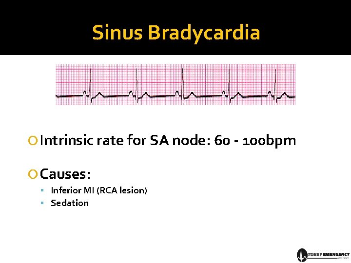 Sinus Bradycardia Intrinsic rate for SA node: 60 - 100 bpm Causes: Inferior MI