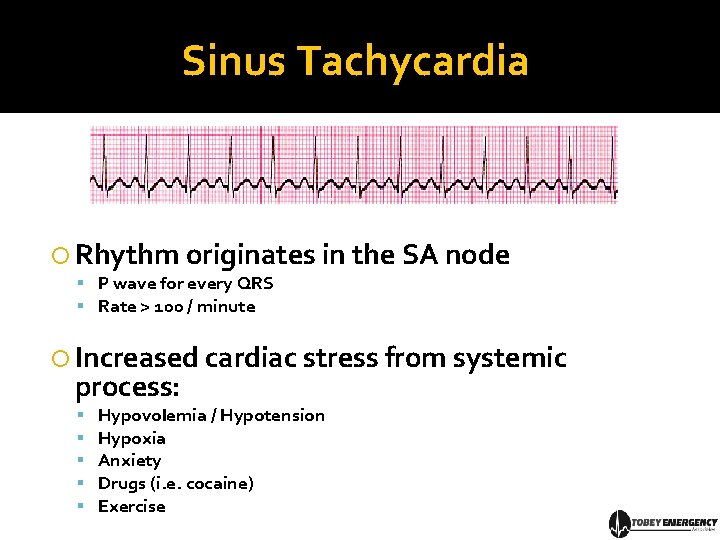 Sinus Tachycardia Rhythm originates in the SA node P wave for every QRS Rate
