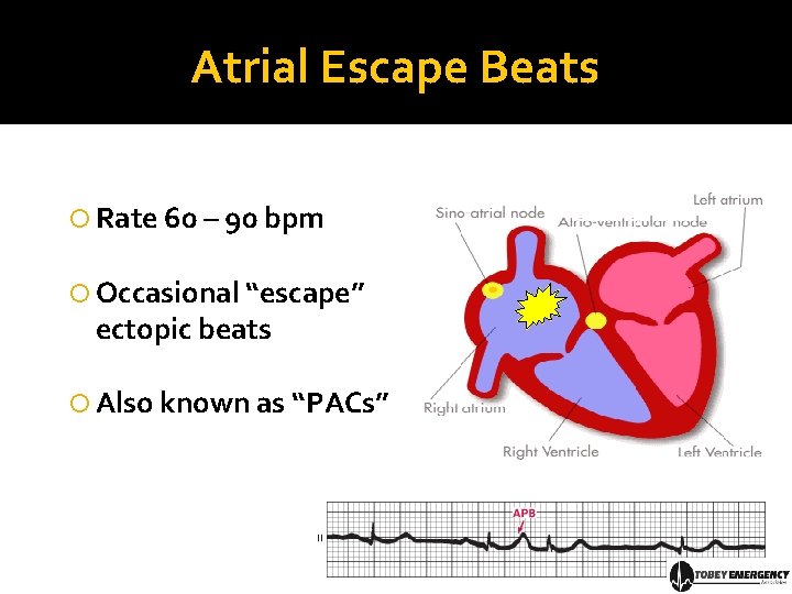 Atrial Escape Beats Rate 60 – 90 bpm Occasional “escape” ectopic beats Also known