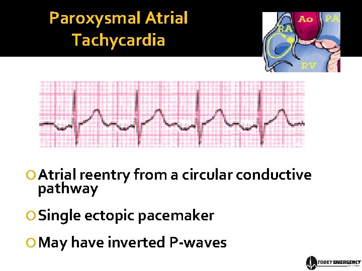 Paroxysmal Atrial Tachycardia Atrial reentry from a circular conductive pathway Single ectopic pacemaker May