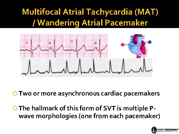 Multifocal Atrial Tachycardia (MAT) / Wandering Atrial Pacemaker Two or more asynchronous cardiac pacemakers