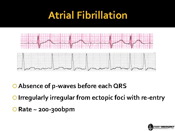 Atrial Fibrillation Absence of p-waves before each QRS Irregularly irregular from ectopic foci with