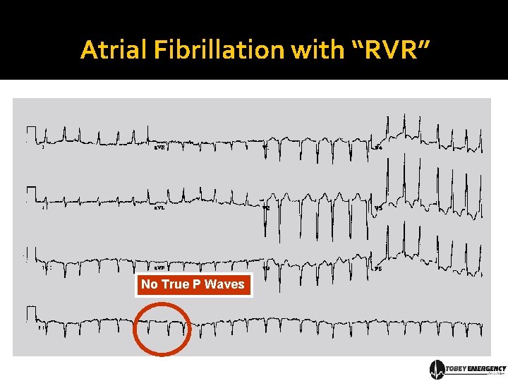 Atrial Fibrillation with “RVR” No True P Waves 