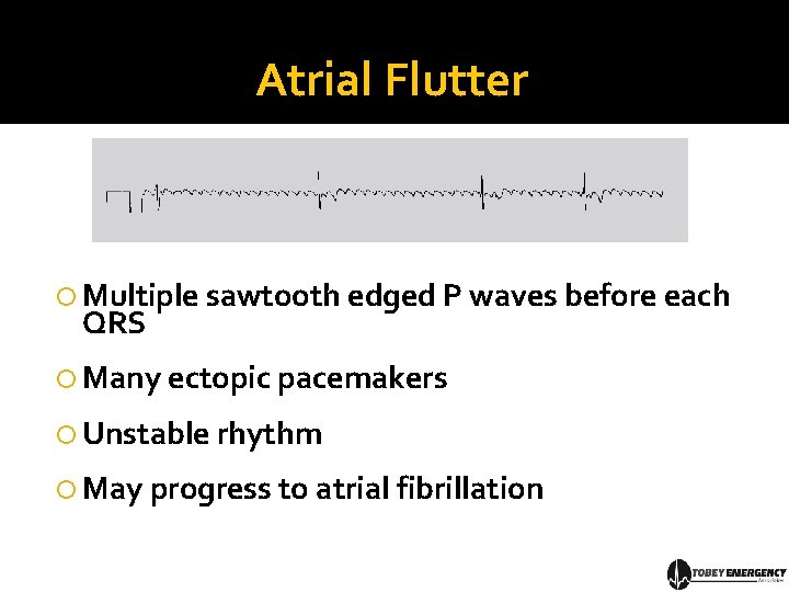 Atrial Flutter Multiple sawtooth edged P waves before each QRS Many ectopic pacemakers Unstable