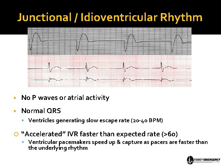 Junctional / Idioventricular Rhythm • No P waves or atrial activity • Normal QRS