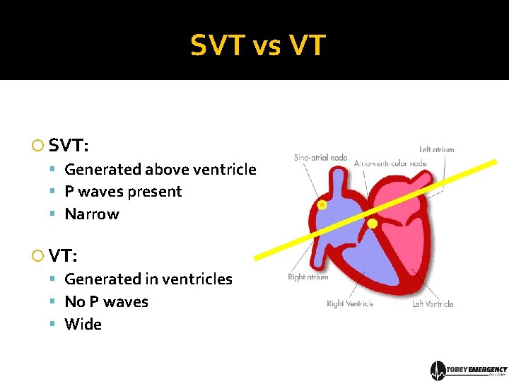 SVT vs VT SVT: Generated above ventricle P waves present Narrow VT: Generated in