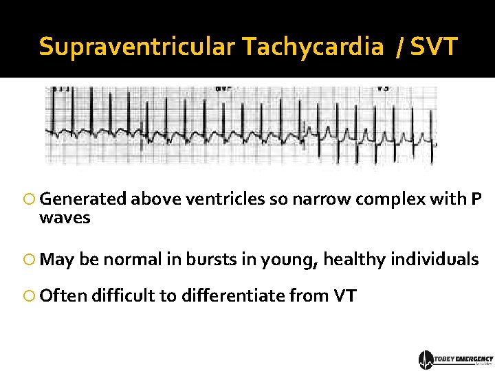 Supraventricular Tachycardia / SVT Generated above ventricles so narrow complex with P waves May