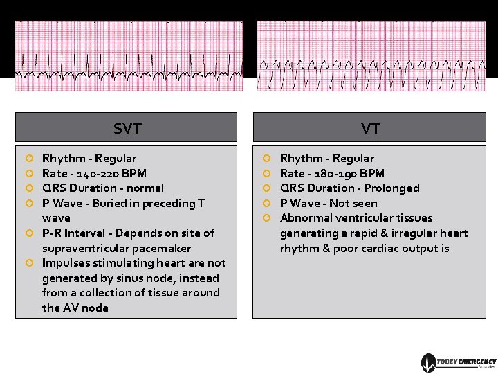 SVT Rhythm - Regular Rate - 140 -220 BPM QRS Duration - normal P