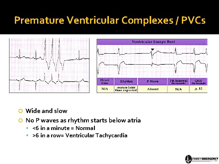 Premature Ventricular Complexes / PVCs Wide and slow No P waves as rhythm starts