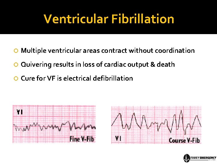 Ventricular Fibrillation Multiple ventricular areas contract without coordination Quivering results in loss of cardiac